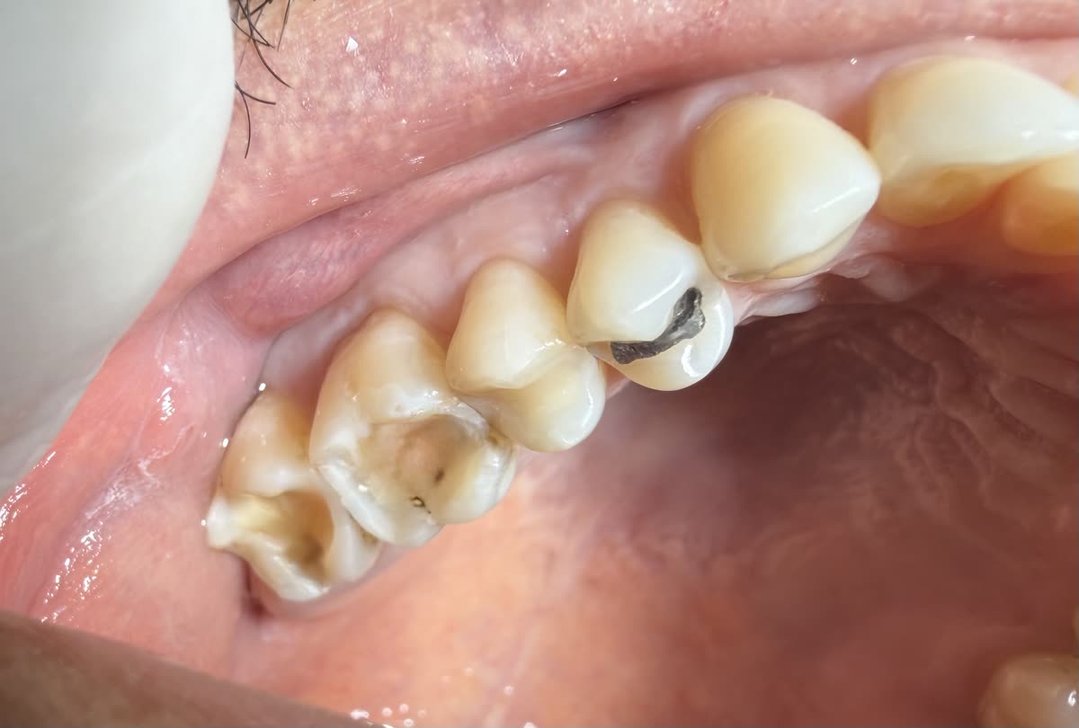Restauração, antes: dentes do fundo com cavidades e uma restauração antiga escura