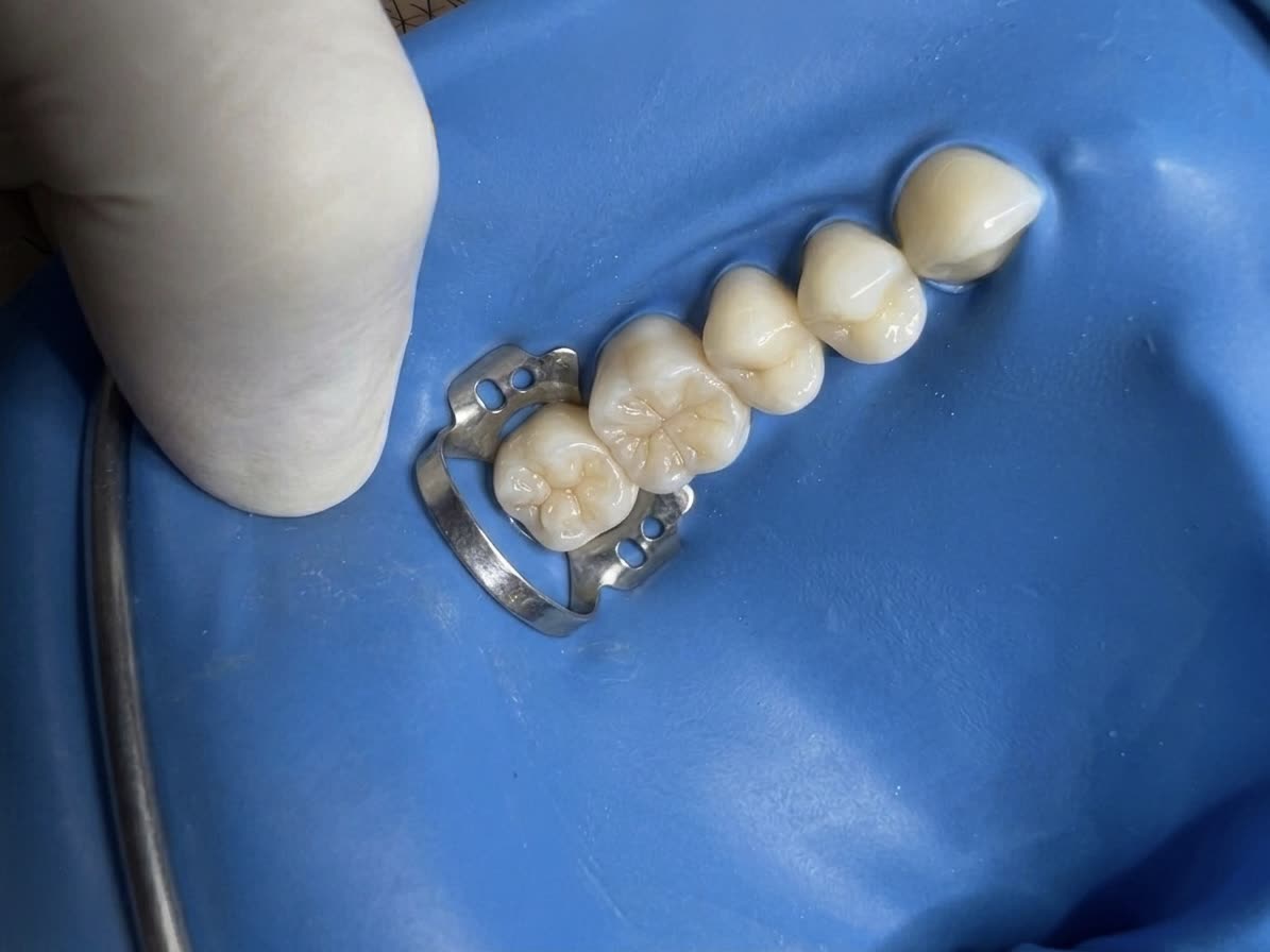 Restauração, depois: os dentes restaurados, durante o atendimento com isolamento